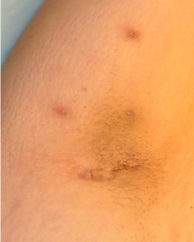 Mild case of hidradenitis suppurativa