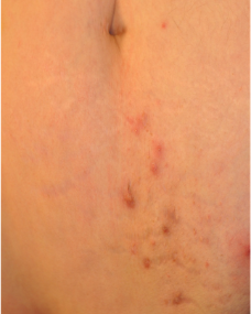 Mild case of hidradenitis suppurativa